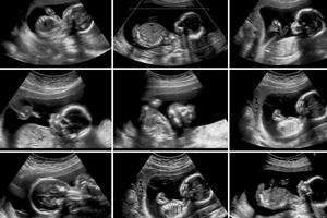 Series of ultrasound images of an unborn baby at 20 weeks. 