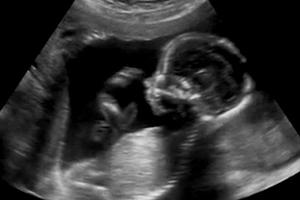  Obstetric ultrasound of a 4-month-old unborn child
