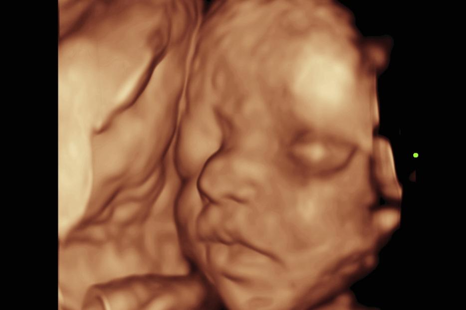 A baby's face in the womb shown using 3-D and 4-D imaging.