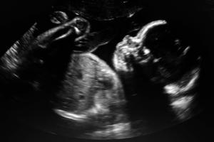 An ultrasound of a baby. An ultrasound of a baby.