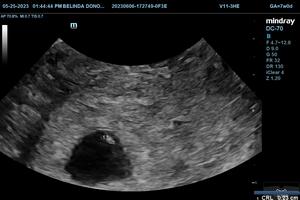 A still ultrasound image shows an unborn baby at 5 weeks 6 days. 