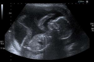 An unborn baby at 20 weeks