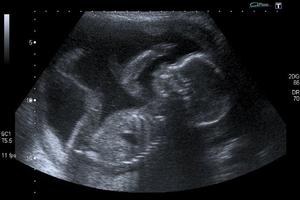An unborn baby at 20 weeks — well within the second trimester, when dilation and evacuation abortions are commonly performed.