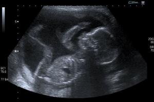 Ultrasound. 