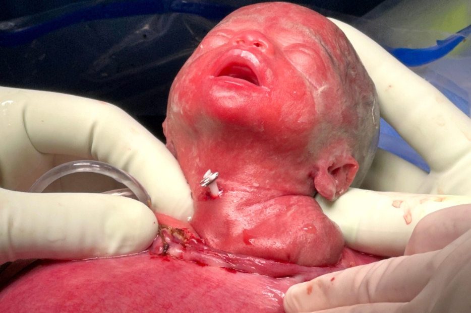Baby Cassian being operated on in utero to fix his airway. 